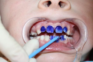 Серебрение зубов – что это